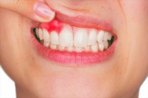 مشکلات دهان و دندان در بیماری سلیاک